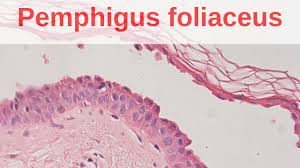 pemphigus foliaceus
